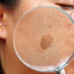 Melasma- causes, symptoms, and diagnosis