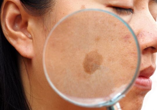 Melasma- causes, symptoms, and diagnosis