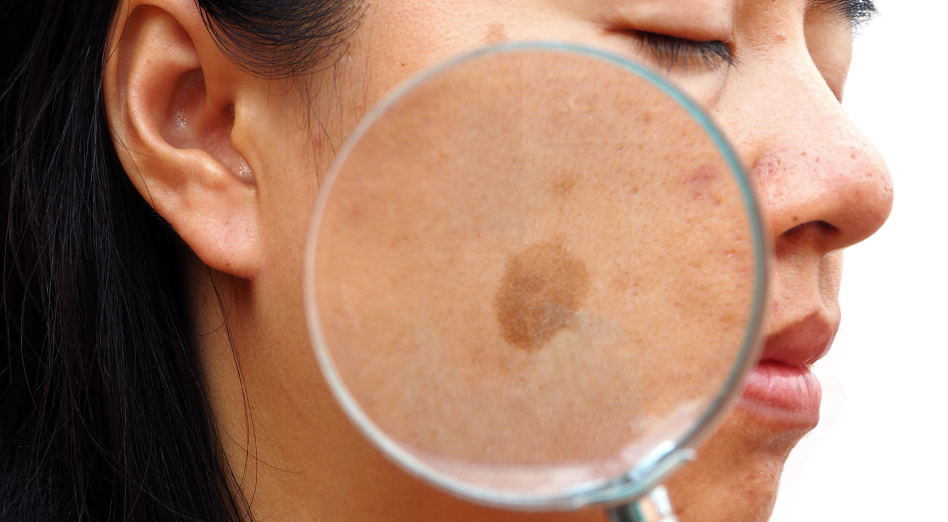 Melasma- causes, symptoms, and diagnosis